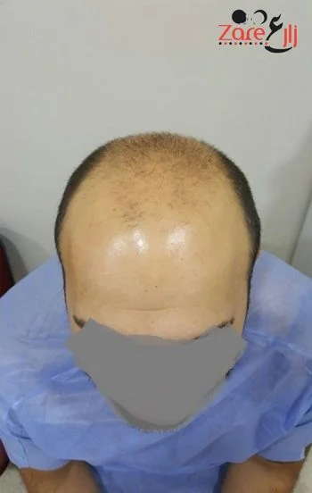  في زراعة الشعر في تركيا للرجال - Zare3.webp