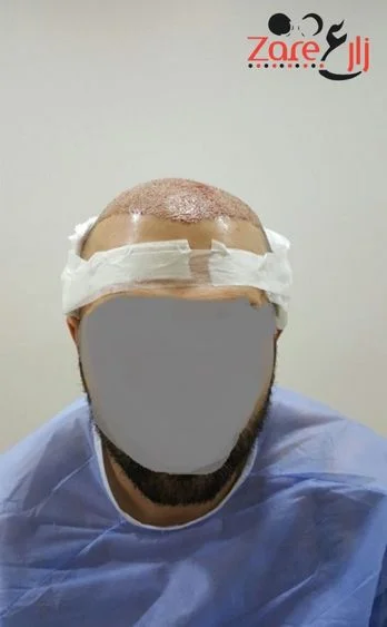  في زراعة الشعر في تركيا للرجال - Zare3 (1).webp