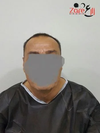  في زراعة الشعر في تركيا للرجال - Zare3 (2).webp