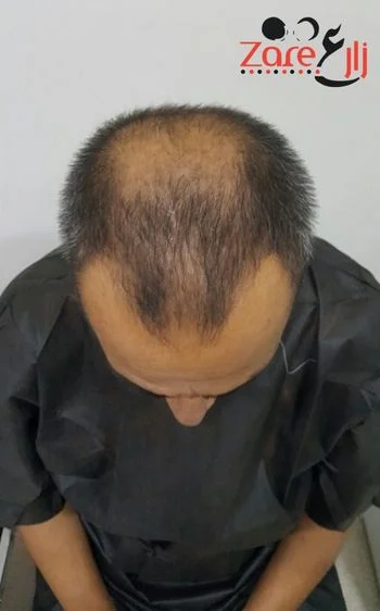  في زراعة الشعر في تركيا للرجال - Zare3 (3).webp