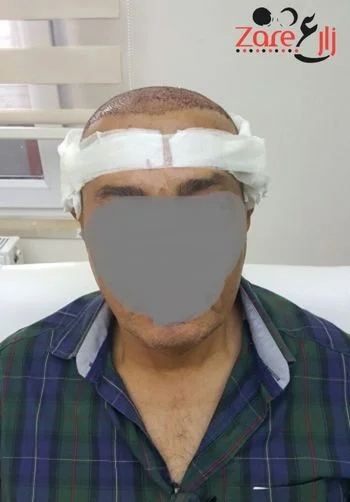  في زراعة الشعر في تركيا للرجال - Zare3 (4).webp