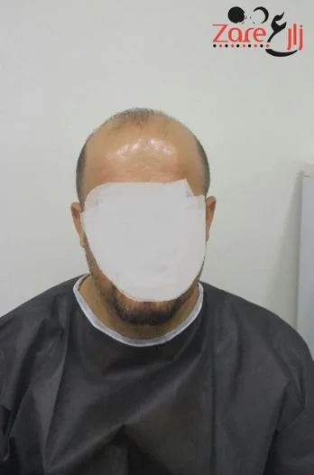  في زراعة الشعر في تركيا للرجال - Zare3 (7).webp