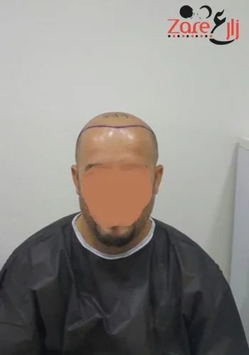  في زراعة الشعر في تركيا للرجال - Zare3 (6).webp