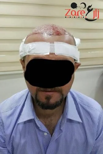  الشعر في تركيا للرجال - 4500 بصيلة - Zare3 (2).webp