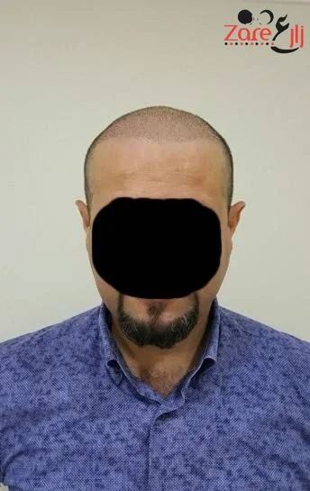  الشعر في تركيا للرجال - 4500 بصيلة - Zare3 (3).webp