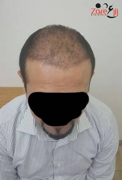  الشعر في تركيا للرجال - 4500 بصيلة - Zare3 (6).webp
