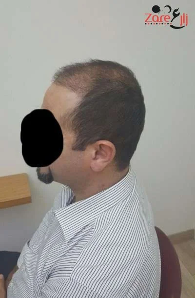  الشعر في تركيا للرجال - 4500 بصيلة - Zare3 (8).webp