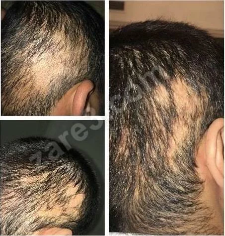 hair_shock_loss.webp