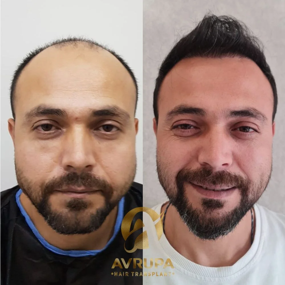 قبل وبعد زراعة 5500 بصيلة شعر