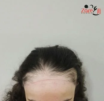  زراعة الشعر للنساء في تركيا - zare3.webp
