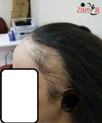  زراعة الشعر للنساء في تركيا - zare3 (1).webp
