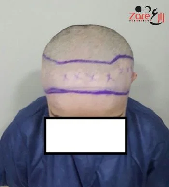  زراعة الشعر للنساء في تركيا - zare3 (2).webp