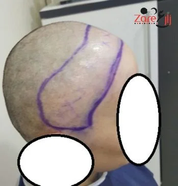  زراعة الشعر للنساء في تركيا - zare3 (3).webp