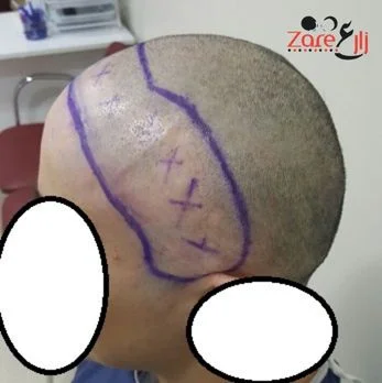  زراعة الشعر للنساء في تركيا - zare3 (4).webp