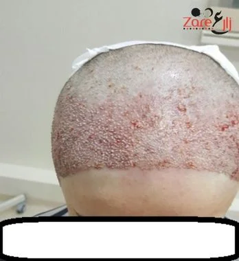  بعد زراعة الشعر للنساء في تركيا - zare3.webp