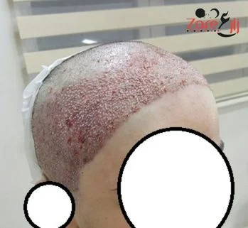  بعد زراعة الشعر للنساء في تركيا - zare3 (1).webp