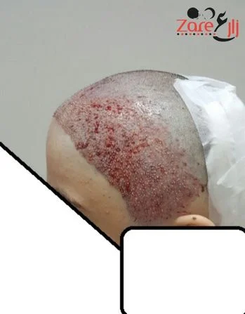  بعد زراعة الشعر للنساء في تركيا - zare3 (2).webp