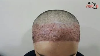 _زراعة الشعر للنساء في تركيا - بعد الغسيل- zare3.webp