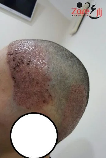 _زراعة الشعر للنساء في تركيا - بعد الغسيل- zare3 (2).webp