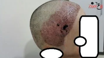 _زراعة الشعر للنساء في تركيا - بعد الغسيل- zare3 (1).webp