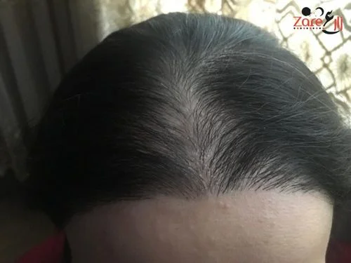 _نتيجتي بعد زراعة الشعر للنساء في تركيا - zare3.webp