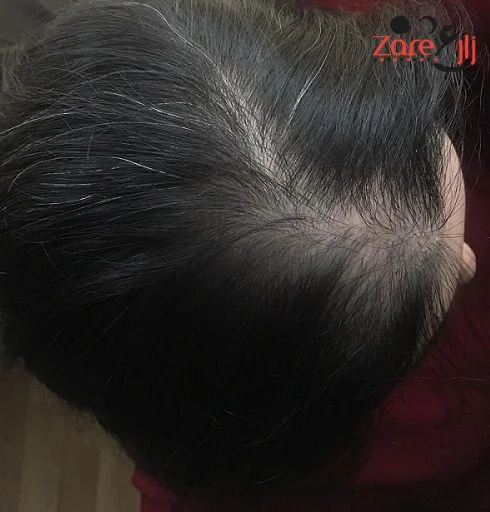 _نتيجتي بعد زراعة الشعر للنساء في تركيا - zare3 (1).webp