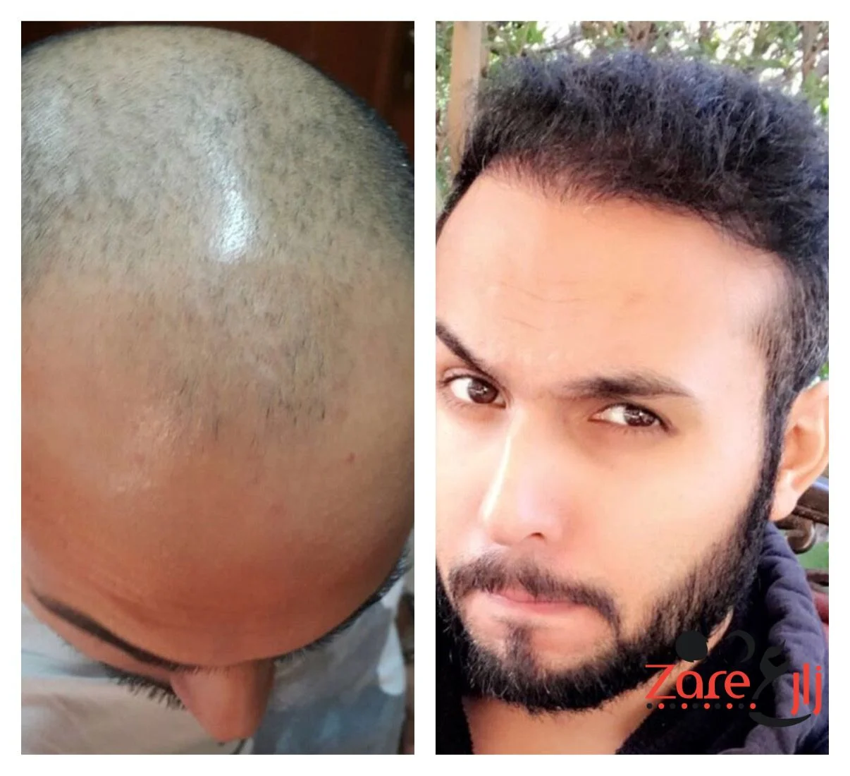  وبعد زراعة الشعر لدى المختص محمد قوتشلو - Zare3.webp