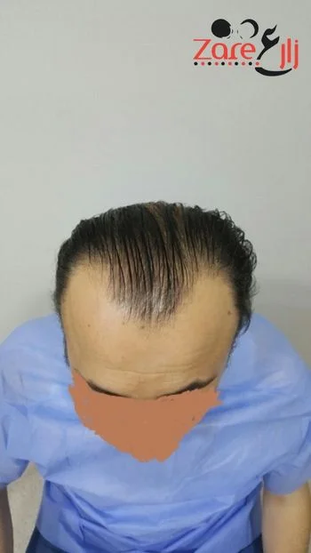  الشعر في تركيا للرجال - 4000 بصيلة - Zare3.webp