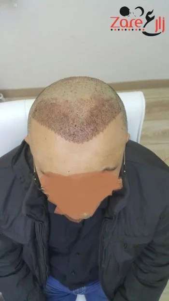  زراعة الشعر في تركيا للرجال - 4000 بصيلة - Zare3.webp