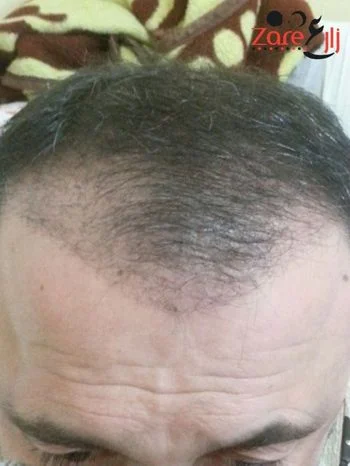  بعد زراعة الشعر في تركيا للرجال - 4000 بصيلة - Zare3.webp