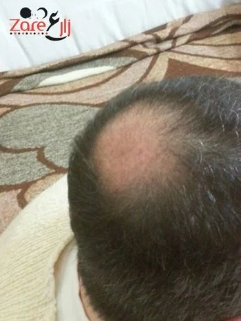  بعد زراعة الشعر في تركيا للرجال - 4000 بصيلة - Zare3 (1).webp