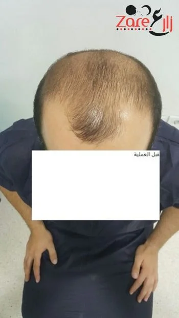  الشعر في تركيا للرجال - 3800 بصيلة - Zare3.webp