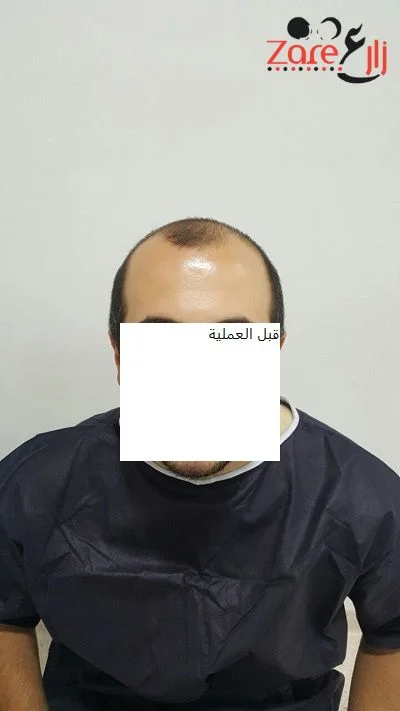  الشعر في تركيا للرجال - 3800 بصيلة - Zare3 (1).webp