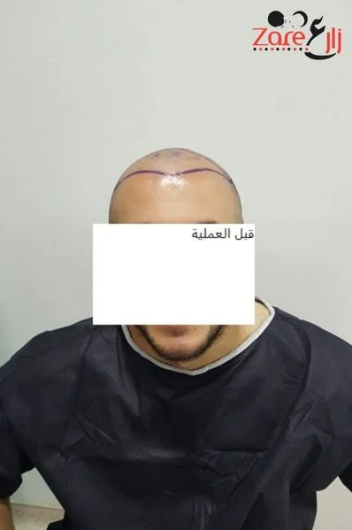  الشعر في تركيا للرجال - 3800 بصيلة - Zare3 (2).webp