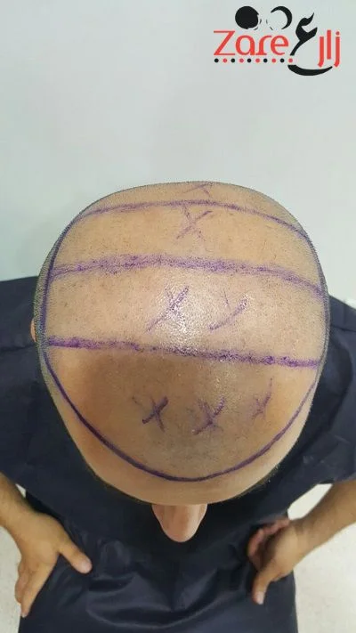  الشعر في تركيا للرجال - 3800 بصيلة - Zare3 (3).webp