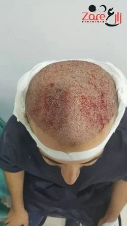  زراعة الشعر في تركيا للرجال - 3800 بصيلة - Zare3 (1).webp