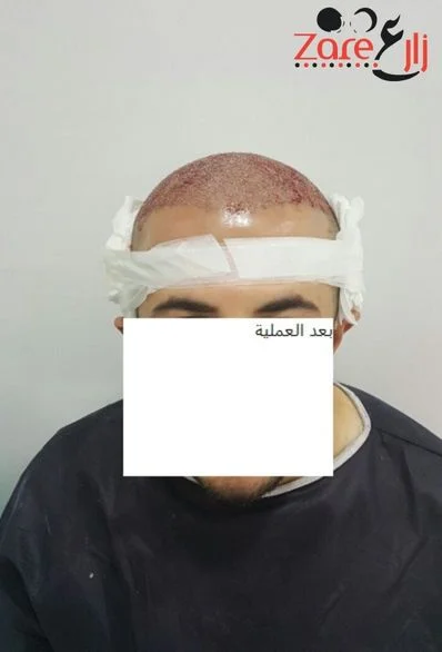  زراعة الشعر في تركيا للرجال - 3800 بصيلة - Zare3.webp