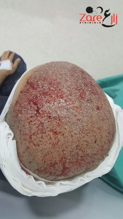  زراعة الشعر في تركيا للرجال - 3800 بصيلة - Zare3 (2).webp