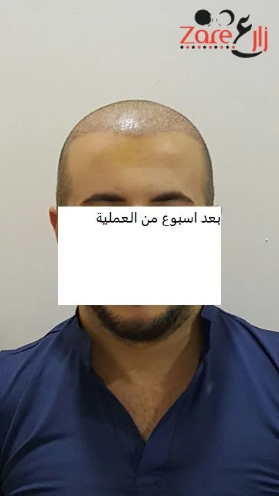  زراعة الشعر في تركيا للرجال - 3800 بصيلة - Zare3 (3).webp