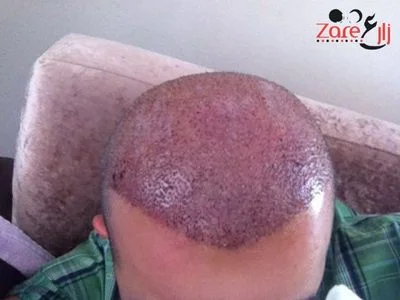  زراعة الشعر في تركيا للرجال - 3800 بصيلة - Zare3 (4).webp