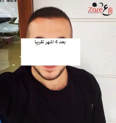  زراعة الشعر في تركيا للرجال - 3800 بصيلة - Zare3 (7).webp