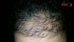 زراعة الشعر للنساء - بعد 109 يوم - Zare3.jpg