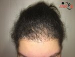 زراعة الشعر للنساء - بعد 5  اشهر- Zare3.jpg