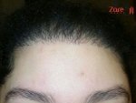 زراعة الشعر للنساء - بعد 6 اشهر - Zare3.jpg