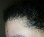 زراعة الشعر للنساء - بعد 6 اشهر - Zare3 (1).jpg