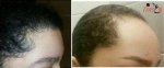 زراعة الشعر للنساء - قبل وبعد 6 اشهر - Zare3.jpg