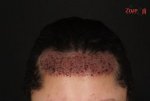 زراعة الشعر للنساء بعد الغسيل - Zare3.jpg