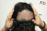 زراعة الشعر للنساء المنطقة المانحة - Zare3.jpg
