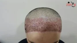 _زراعة الشعر للنساء في تركيا - بعد الغسيل- zare3.webp