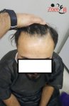 قبل زراعة الشعر في تركيا للرجال - Zare3.jpg